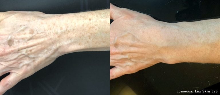 Lumecca Hand - 14