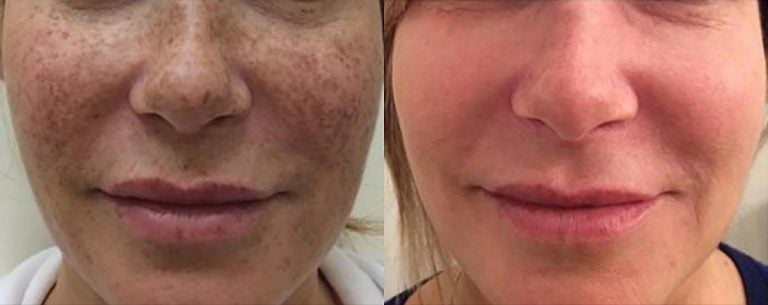 Lumecca Freckles - 15