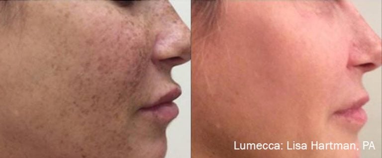 Lumecca Freckles - 16