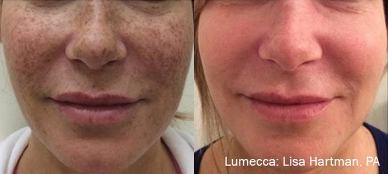 Lumecca Freckles - case 16