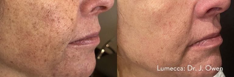 Lumecca Face - 18