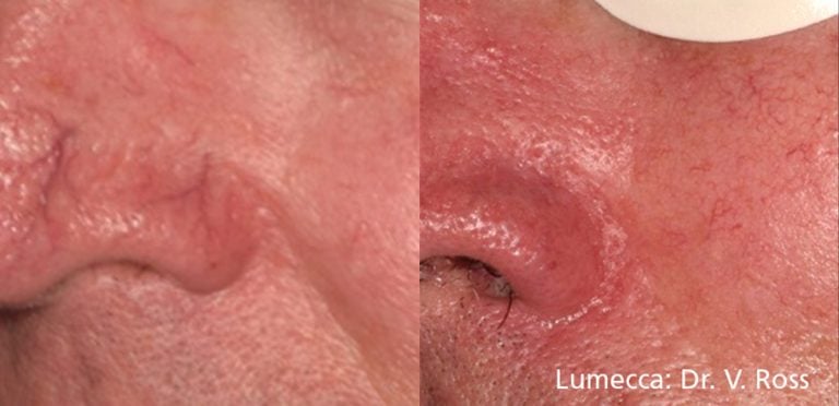 Lumecca Nose - case 26