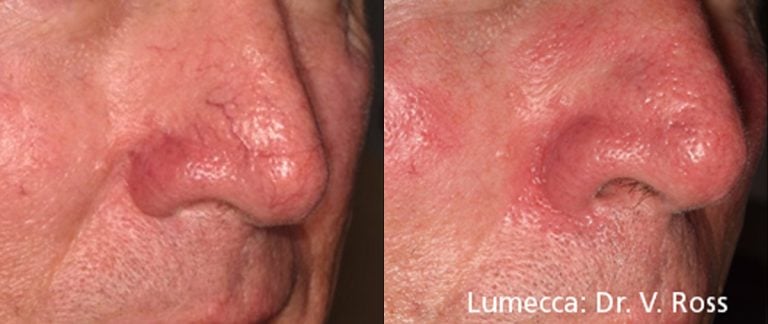 Lumecca Nose - 26