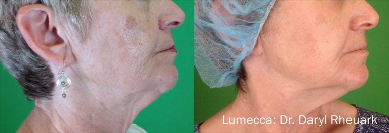 Lumecca Scaled - 29