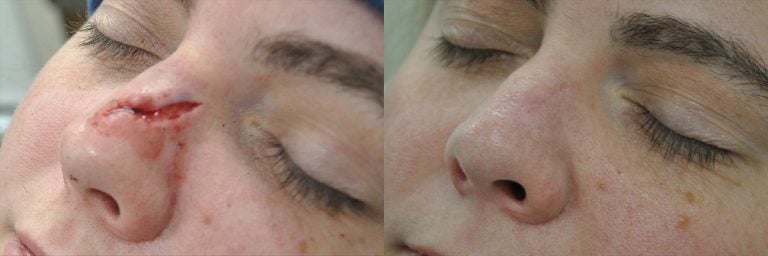 33-year-old 3 months after laceration repair of nose
