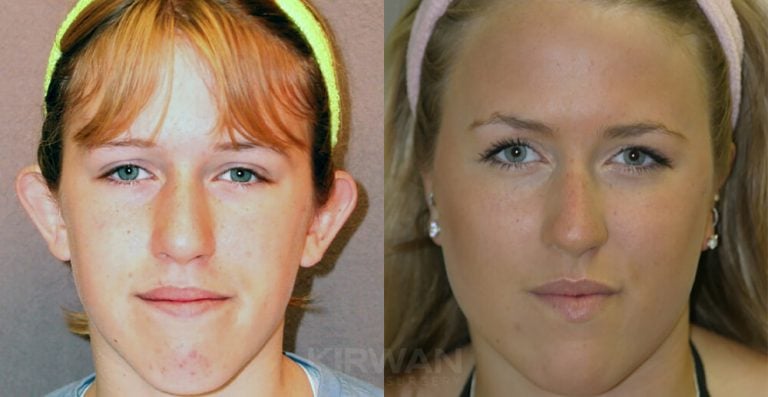 13-year-old female, bilateral otoplasty
