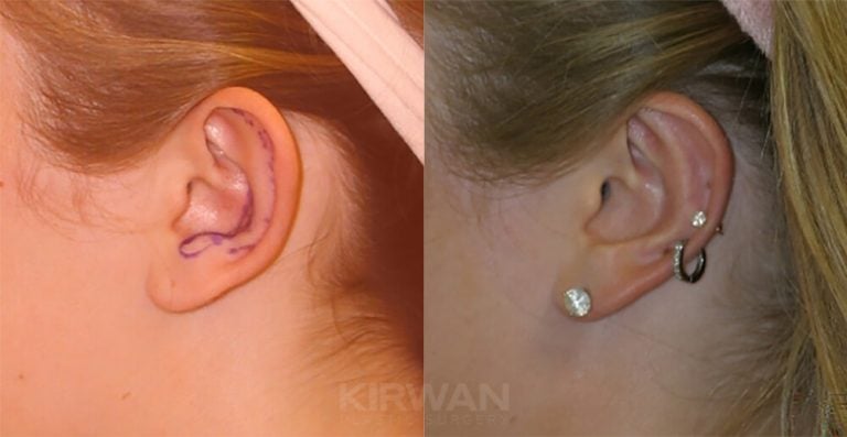 13-year-old female, bilateral otoplasty, 6 years, left ear
