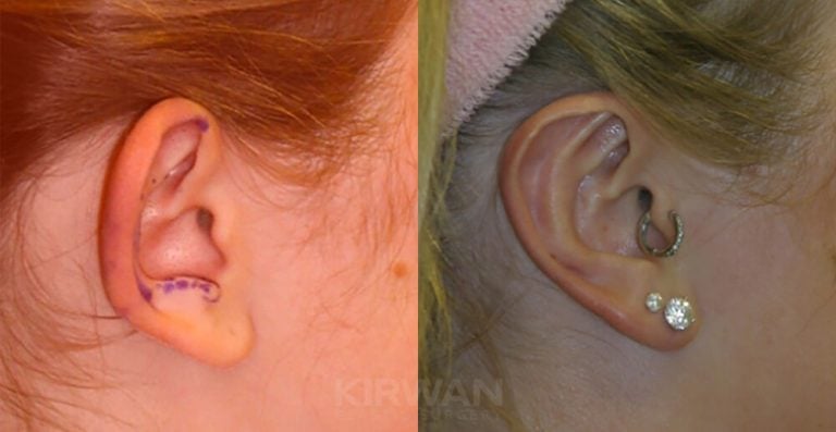 13 year old female bilateral otoplasty - right ear