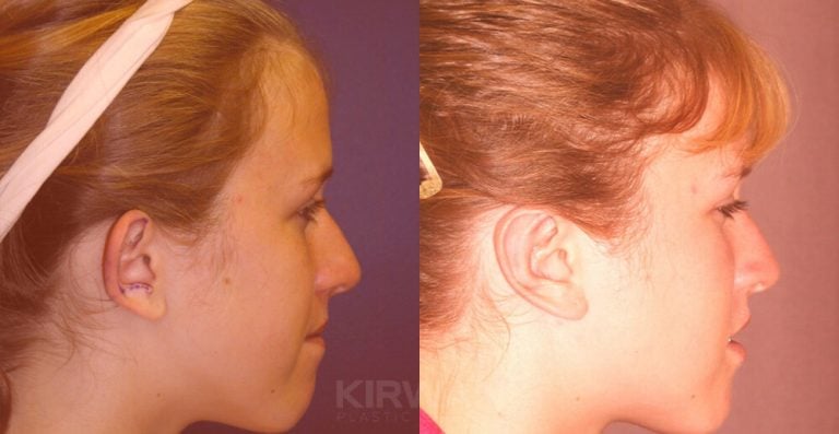 13-year-old female, bilateral otoplasty, right side