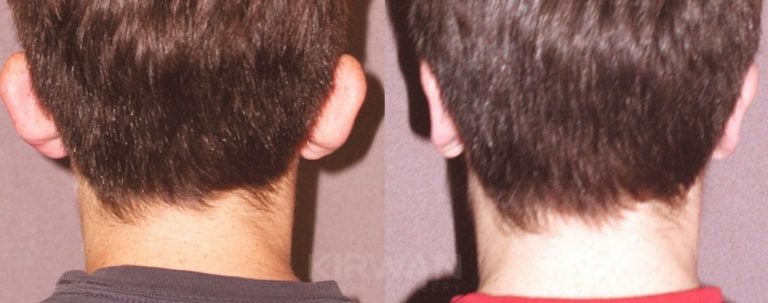 14-year-old, patient A, bilateral otoplasty, 7 months, back view