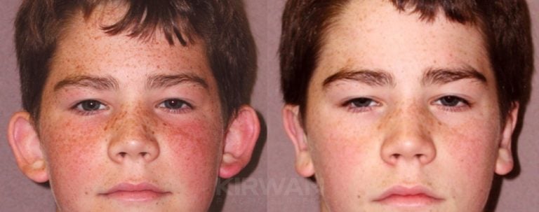 14-year-old, Patient A, bilateral otoplasty, 7 months, front