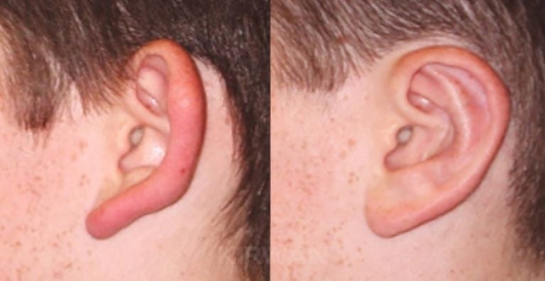 14-year-old, patient A, bilateral otoplasty, 2 months, left ear