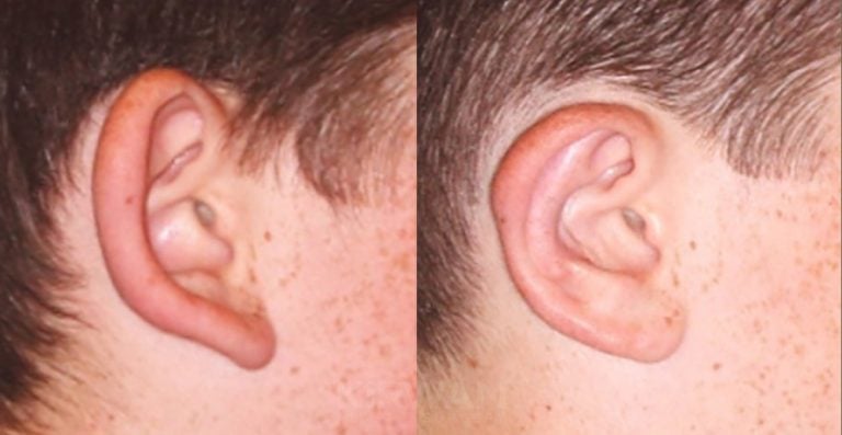 14-year-old, Patient A, bilateral otoplasty, 2 months, right ear