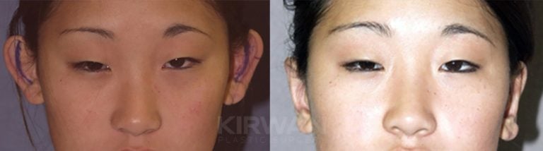 17-year-old female 2 years after otoplasty (19-years-old) front