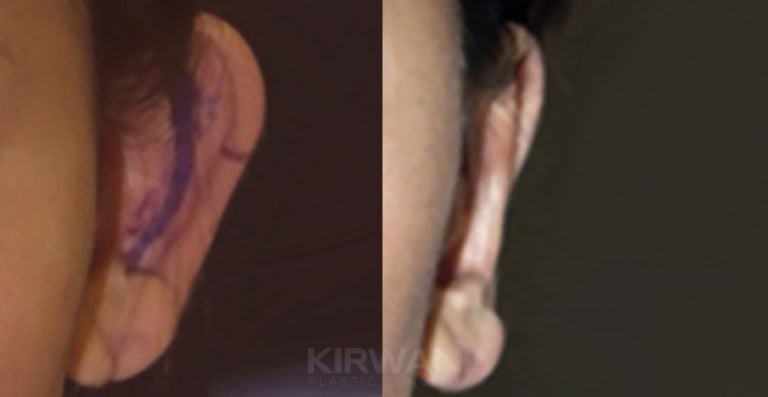 17-year-old female bilateral otoplasty, 2 years (19-years-old), left ear