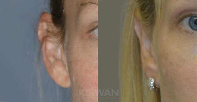 33-year-old female bilateral otoplasty, two years, right ear