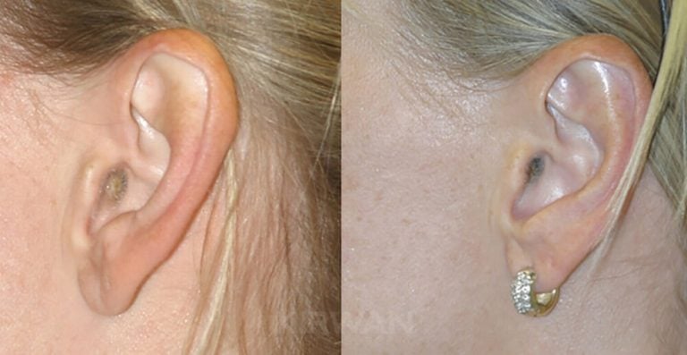 33-year-old female bilateral otoplasty, two years, left ear, side