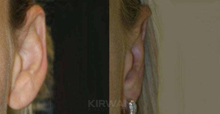 33-year-old female bilateral otoplasty, two years, left ear, side