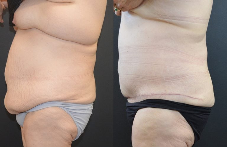56-year-old, 4 months after panniculectomy and liposuction back, side view