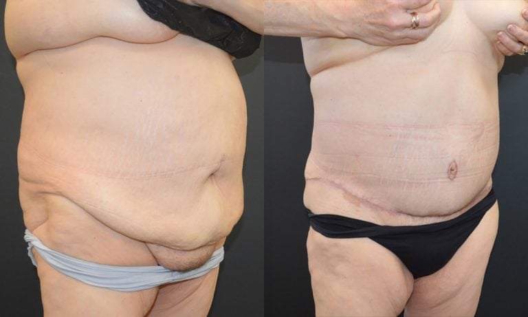 56-year-old, 4 months after panniculectomy and liposuction back, oblique