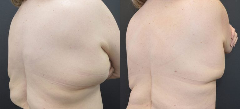 56-year-old, 4 months after panniculectomy and liposuction back, oblique right posterior