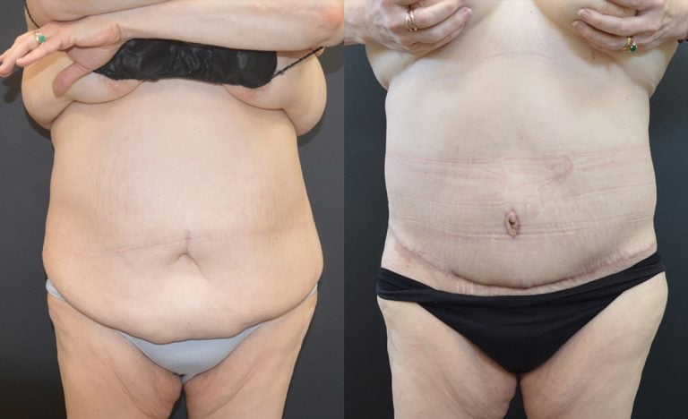 56-year-old, 4 months after panniculectomy and liposuction back, front