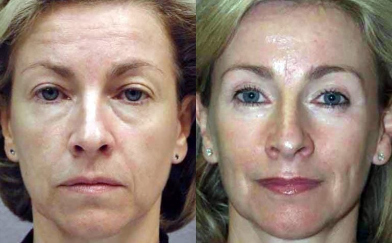 Blepharoplasty - 18
