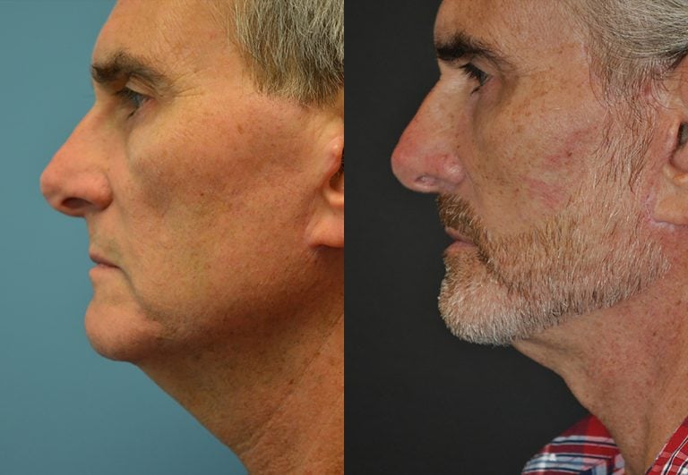 Facelift and neck lift 6 months, side