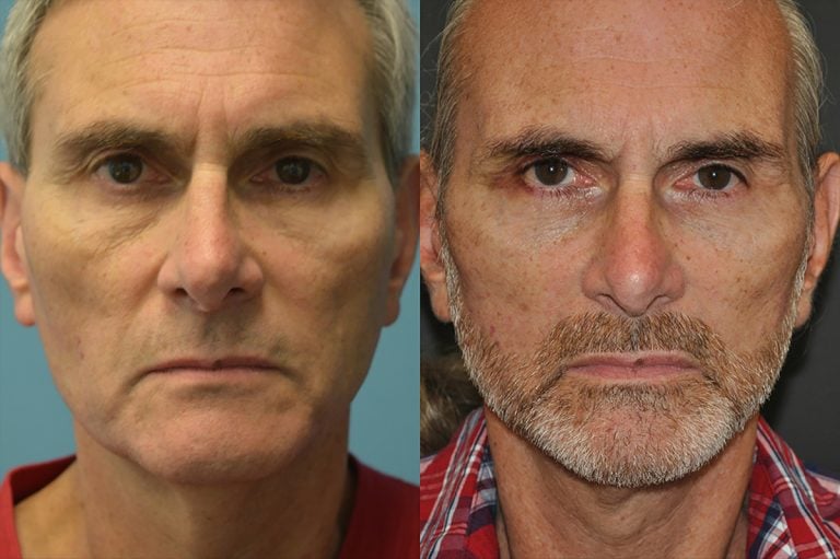 Facelift and neck lift 6 months, front