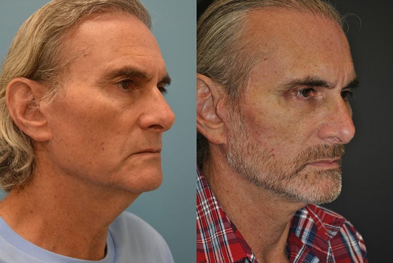 Facelift and neck lift 6 months, oblique