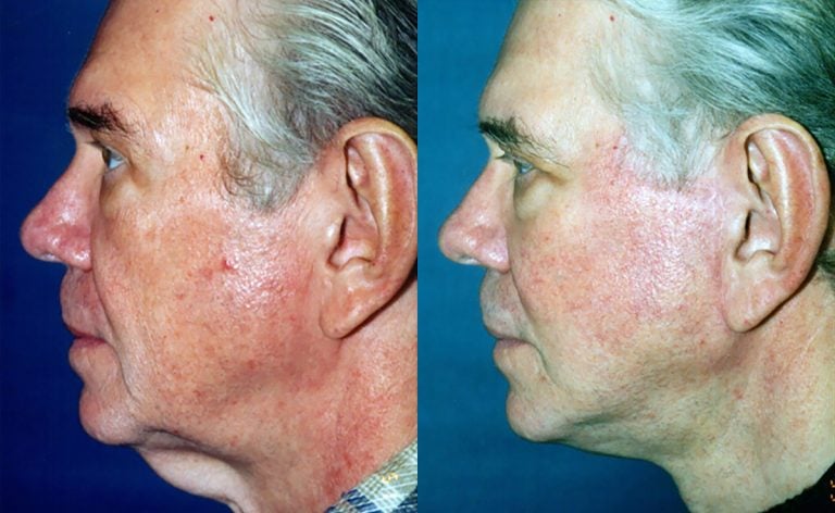 60-year-old male, one year after facelift and neck lift, side
