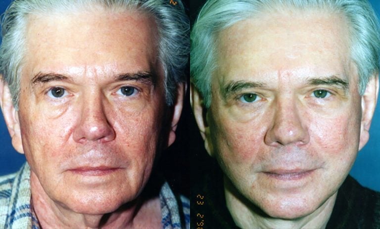 60-year-old male, one year after facelift and neck lift, front