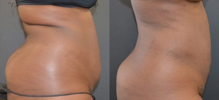 34-year-old 9 months after first liposuction of back and abdomen and one month after 2nd lipo and BodyTite and BodyTite abdomen, side