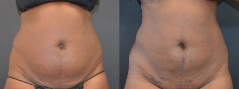 34-year-old 9 months after first liposuction of back and abdomen and one month after 2nd lipo and BodyTite abdomen, front