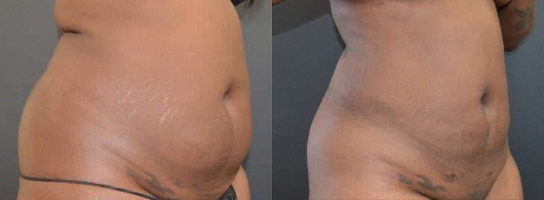34-year-old 9 months after first liposuction of back and abdomen and one month after 2nd lipo abdomen, oblique