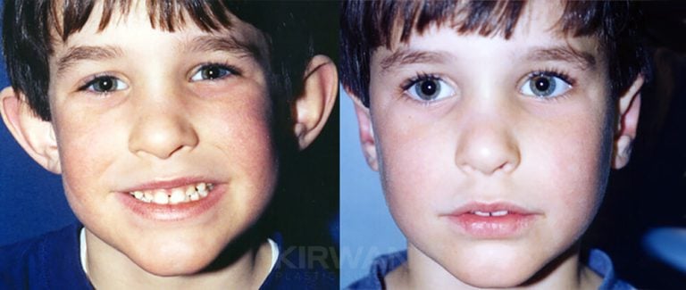 Male bilateral otoplasty, front