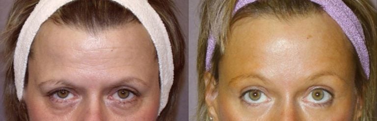 Browlift - 11