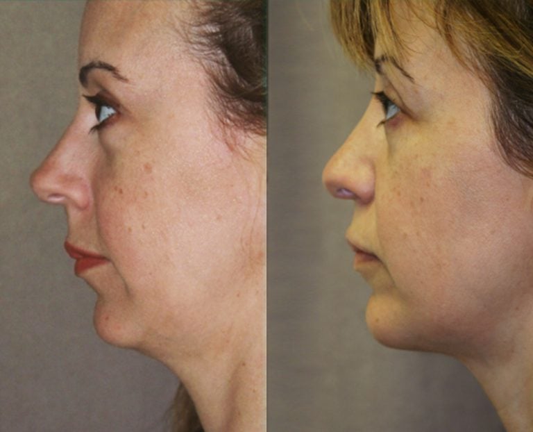 Chin Augmentation