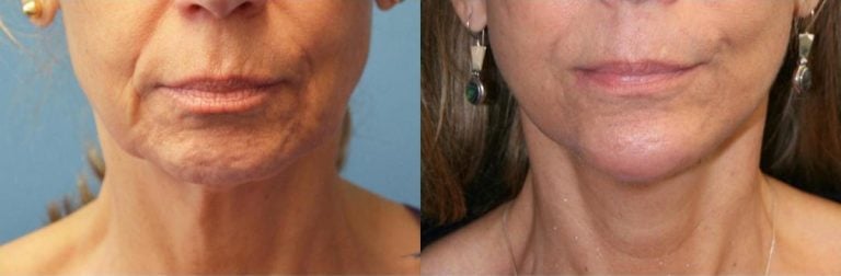 60 year old, Facelift, Endoscopic Browlift, Chin Implant 4 months after surgery (cropped for privacy)