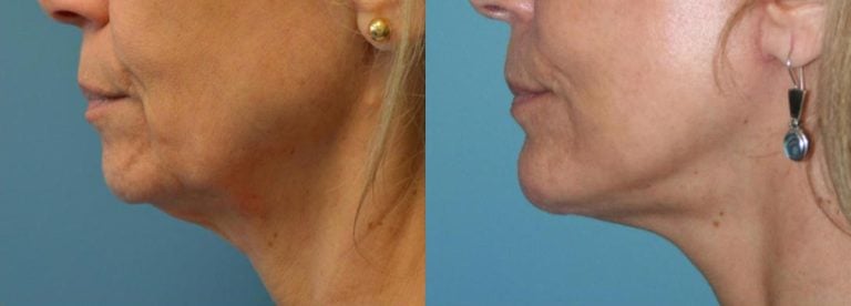 60-year-old, Facelift, Endoscopic Browlift, Chin Implant 4 months after surgery (cropped for privacy)