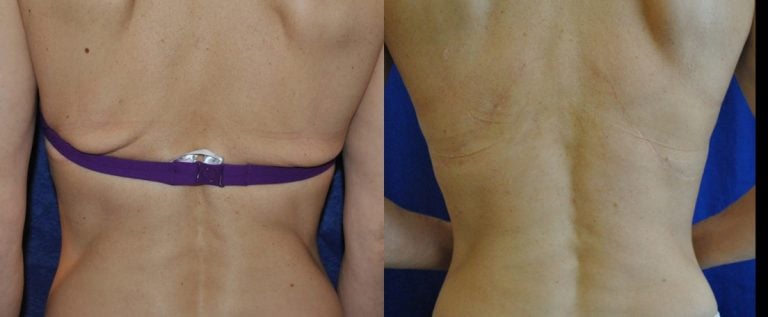 Flank Lift - Image 5