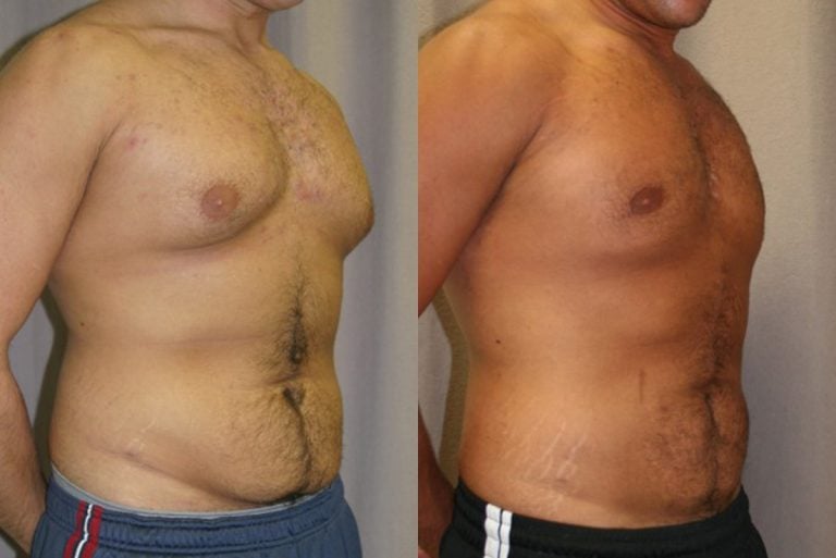 Gynecomastia for Men - 4