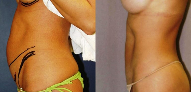 Mini Tummy Tuck