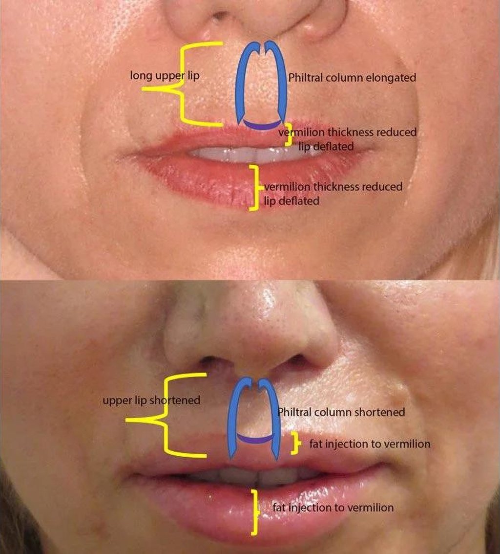 54 year-old patient, lip lift and fat injections to lips - 1