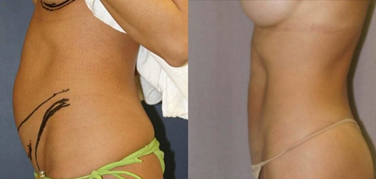 Abdominoplasty - Before & After Results 34