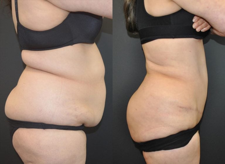 Abdominoplasty - Before & After Results 35