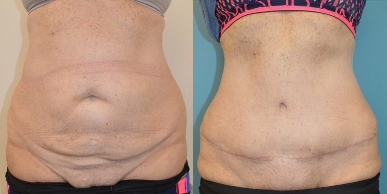 Abdominoplasty - Before & After Results 36