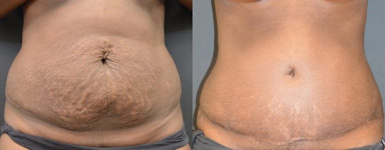 Abdominoplasty - Before & After Results 37