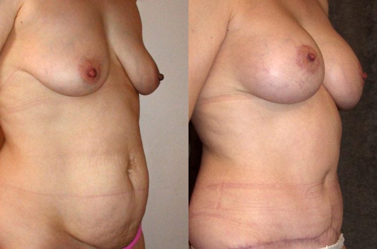 Abdominoplasty - Before & After Results 38