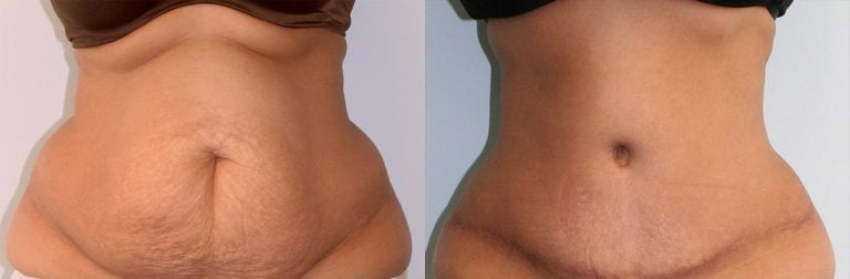 Abdominoplasty - Before & After Results 39
